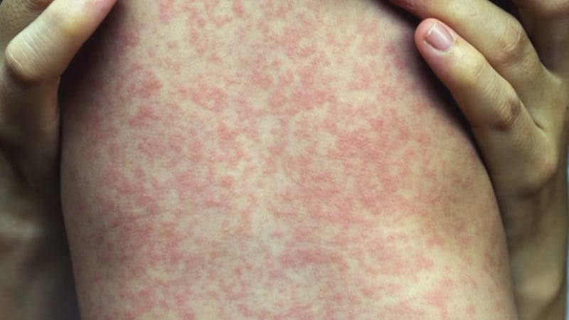 The city of Lubbock is receiving more than $122,000 from the CDC Foundation’s Measles...